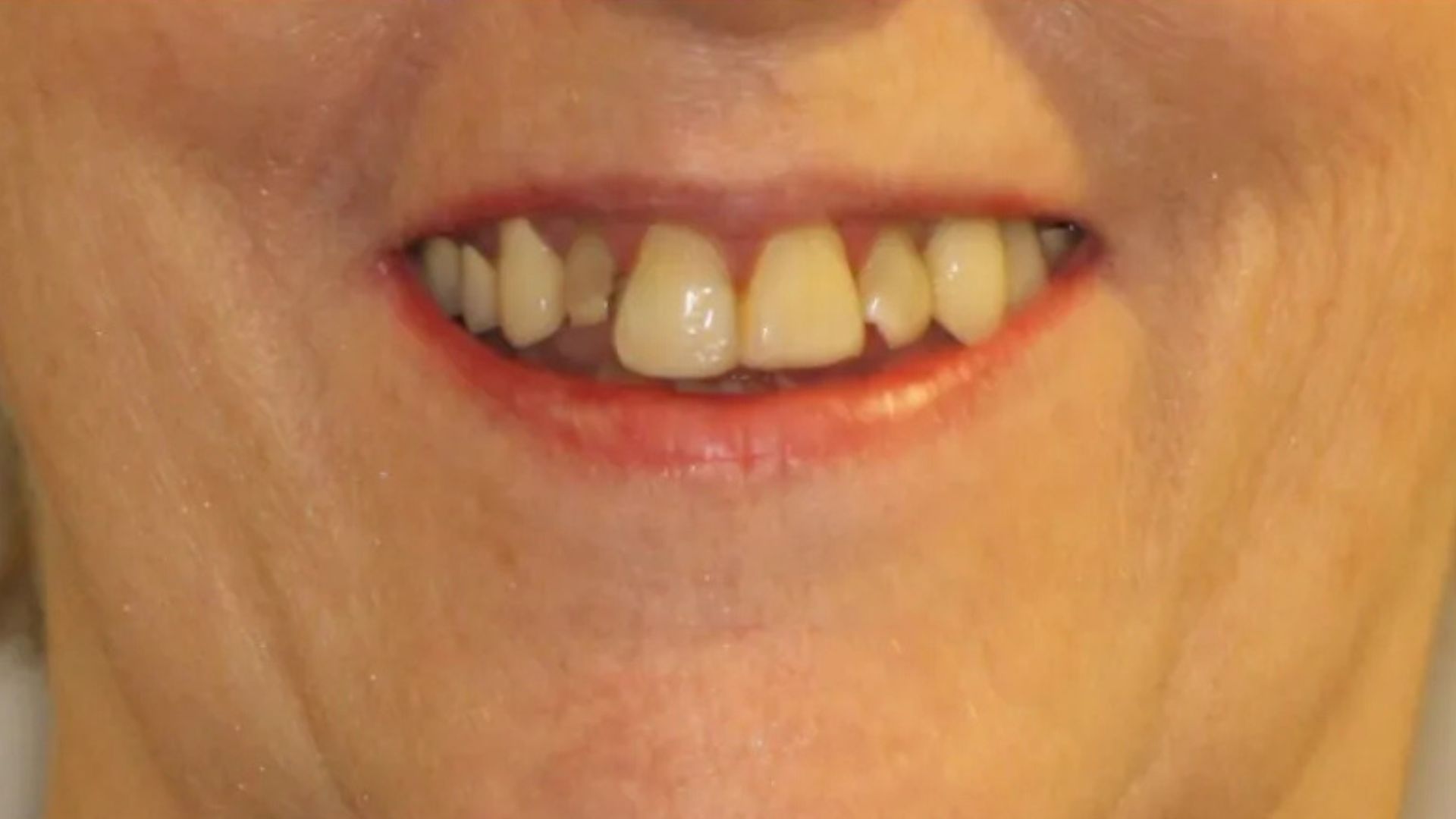 Dental implants before and after (1)