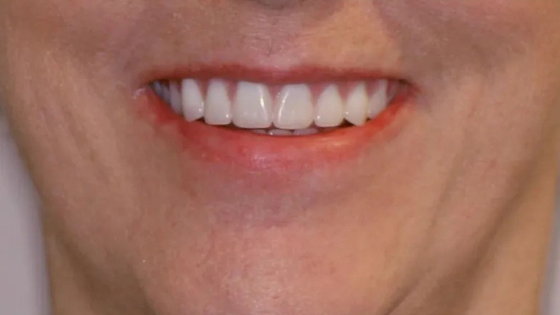 Dental implants before and after